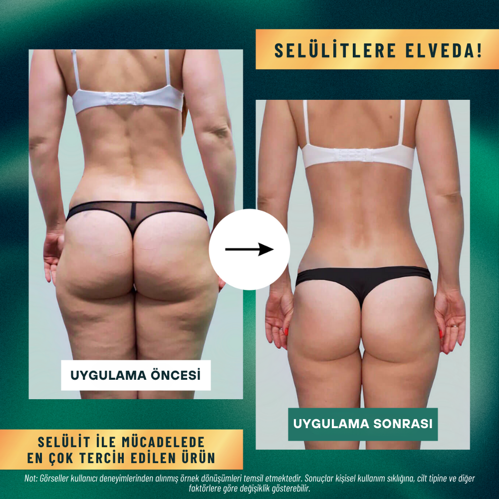 SilkShape™ Pro - Selülit Karşıtı Sıkılaştırıcı Masaj Aleti